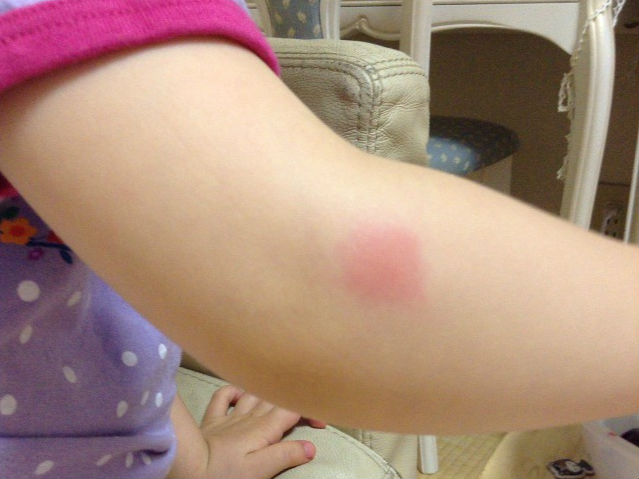 蚊に刺された娘の腕